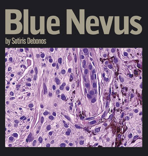 Sotiris Debonos - Blue Nevus Sotiris Debonos - Blue Nevus